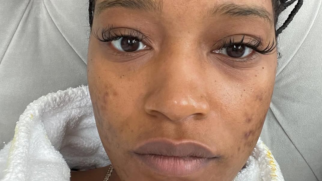 What the internet still gets wrong about acne positivity